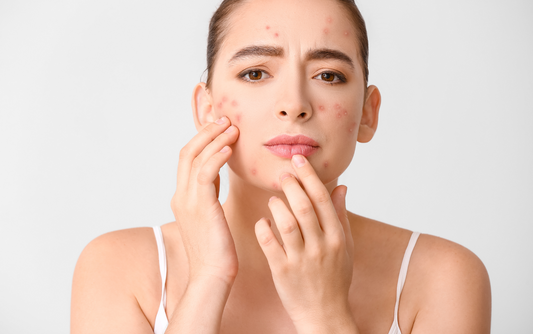 The Role of Micellar Water in Fighting Acne-Causing Bacteria